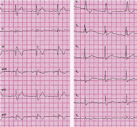 Interpretacyjne Rozdro A Zapisu Ekg Ekg Cykle Tematyczne Artyku Y