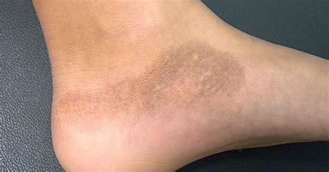 Post Inflammatory Hypopigmentation Viquepedia