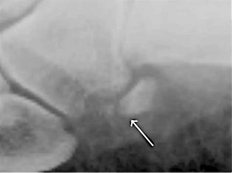 Painful Os Peroneum Robert Sheinberg Dpm Weston Fl Podiatrist