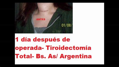 Cirug A De Tiroides Cicatriz De Tiroidectom A Total Youtube