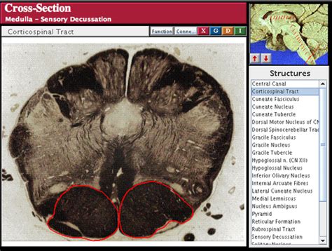 Brainstem Coronal Slices Flashcards Quizlet