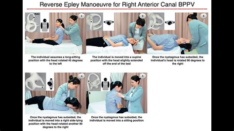 Reverse Epley Manoeuvre For Right Anterior Canal BPPV YouTube