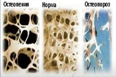 Защита от остеопороза.