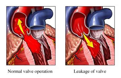 Finding A Really Good Surgeon To Treat Aortic Insufficiency Or Stenosis