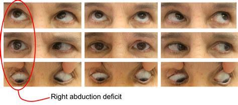 Sixth Nerve Palsy Case Based Neuro Ophthalmology