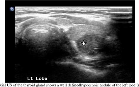 Thyroid Cyst Ultrasound