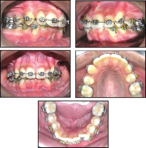 Case Report Correction Of Class Ii Div 2 Malocclusion With Maxillary Arch Extraction And Lower