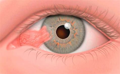 Pterígio Clínica de Olhos Manaus