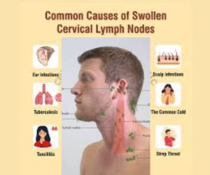 Decoding Cervical Lymphadenitis Causes Symptoms Diagnosis Treatment