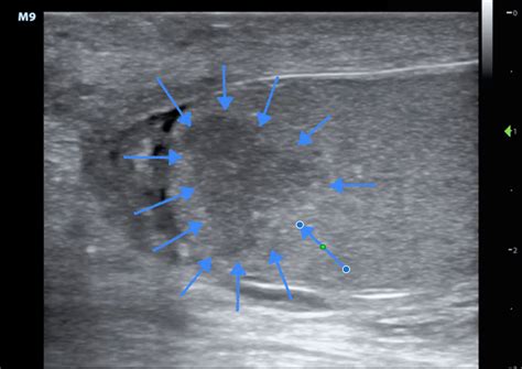 Epididymitis Ultrasound