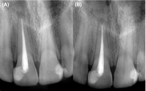 Follow‐up Radiographs A 6‐mo Follow‐up B 12‐mo Follow‐up Shows