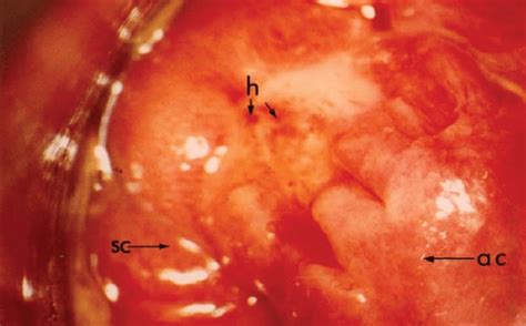 Rectal Mucosa In Moderate Proctitis Sc ¼ Severe Congestion H ¼ Download Scientific Diagram