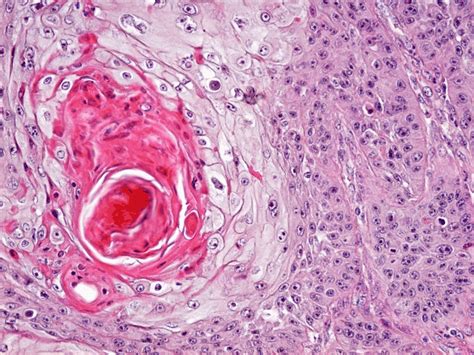 Well Differentiated Squamous Cell Carcinoma Keratinizing Type He