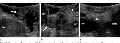 Figure 21 From Intraoperative Ultrasonography Of The Pancreas Semantic Scholar