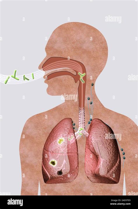 Progression Of Tuberculosis Cutaway Computer Illustration Showing