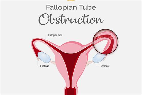 What Is The Cause Of Blocked Fallopian Tubes Fibroid Treatment Clinic