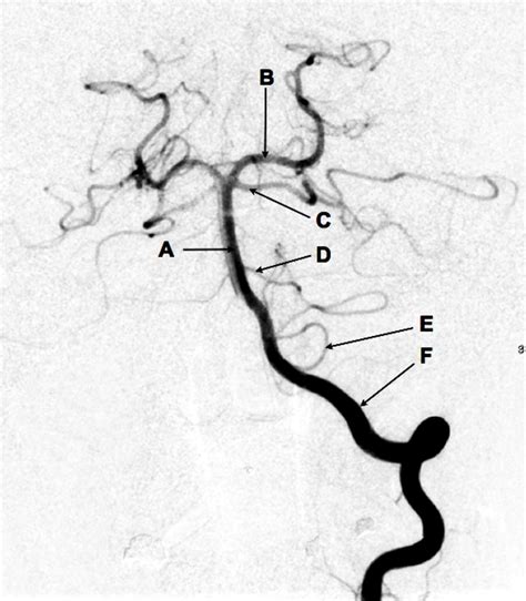 Anteroposterior Left Vertebral Angiogram The Bmj