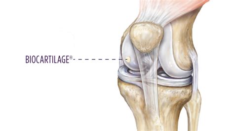 Knee Cartilage Injury Treatment Options Summit Orthopedics