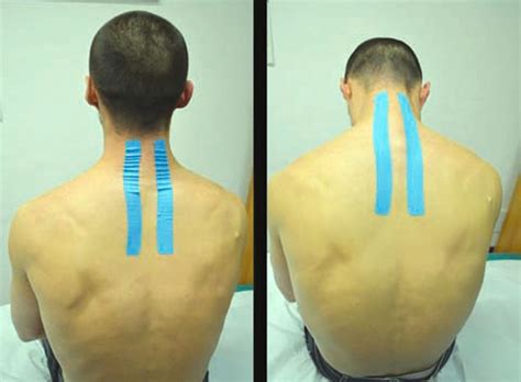 Contracturas En El Cuello