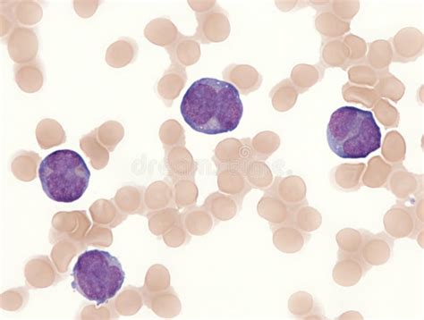 Acute Promyelocytic Leukemia Bone Marrow Stock Photo Image Of