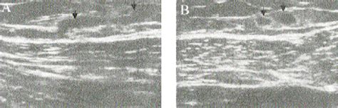 Figure From A Case Of Breast Sparganosis Semantic Scholar