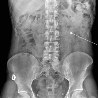 Radiografía de abdomen 2 días antes de la consulta se observa una