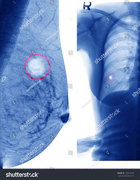 X-Ray Of Breast Cancer Stock Photo 145412332 : Shutterstock