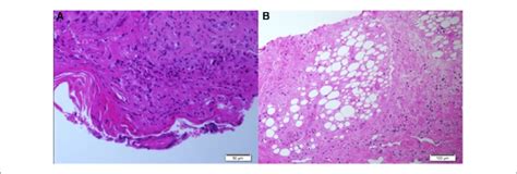 A B Histopathological Findings Of Skin Biopsies Epidermal Necrosis