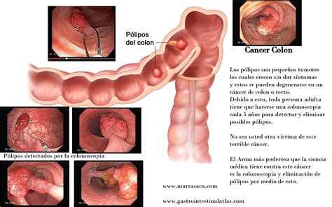 Colonoscopia Gastroenterologo El Salvador Gastroenterologo El Salvador