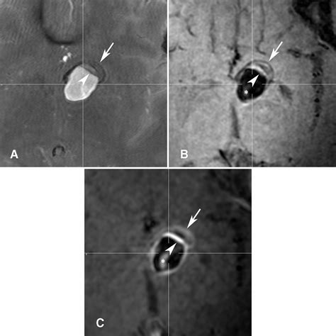 Vessel Wall Imaging In Intracranial Aneurysms Journal Of