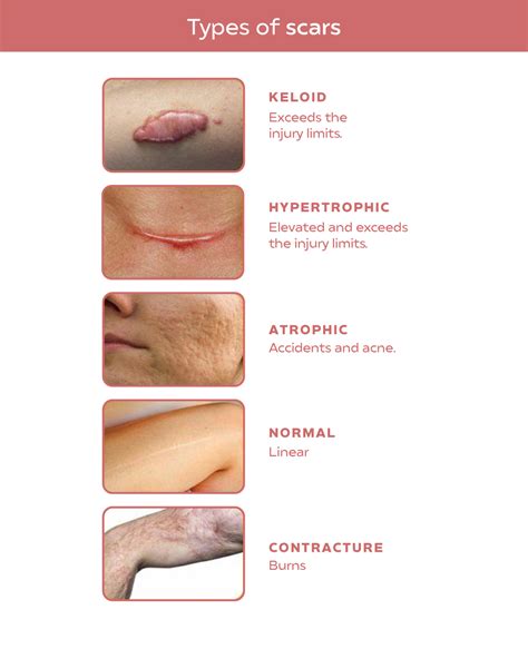 Differences Between Keloids And Hypertrophic Scars Omicroart