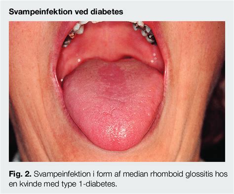 Yeast Infection In The Shape Of Median Rhomboid Glossitis Seen In A Download Scientific Diagram