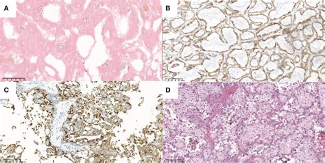 Frontiers Case Report The Ultrasound Features Of Acquired Cystic