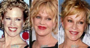 Melanie Griffith Plastic Surgery: Lip Augmentation, Facelift, Botox