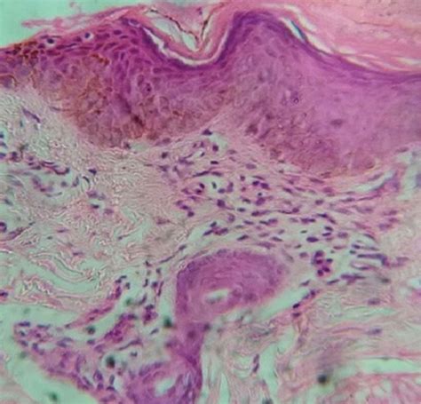 Polymorphous Light Eruption Histology