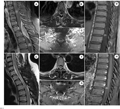 Figure From Multiple Ossified Intracranial And Spinal Meningiomas A