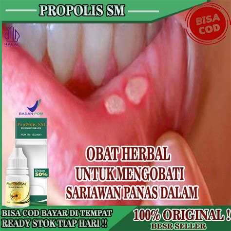 Jual Obat Sariawan Panas Dalam Bibir Pecah Pecah Kering Propolis Sm