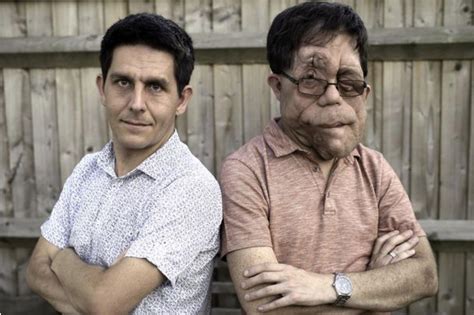 Identical twin brothers Neil and Adam Pearson have neurofibromatosis ...