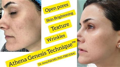 Athena Genesis Technique For Pigmentation Open Pores Rejuvenation