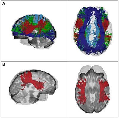 Frontiers Sex Related Differences In White Matter Asymmetry And Its