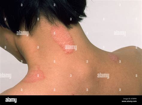 Neurodermatitis Hi Res Stock Photography And Images Alamy