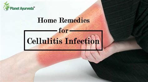 Symptoms Of Cellulitis Infection Archives Planet Ayurveda