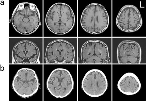 Figure1 Brain MRI And CT Images Of The Patient A MRI T1 Weighted