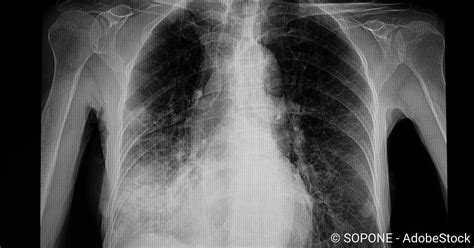 Lungenentz Ndung Pneumonie Netdoktor Ch