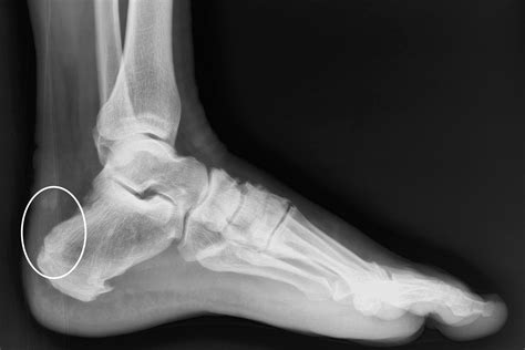 Achilles Tendonitis — Daniel Bohl, MD | Midwest Orthopaedics at RUSH