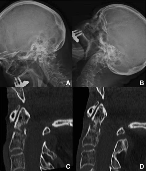 Dynamic Cervical Spine X Rays Flexion A Extension B At 3 Months Download Scientific