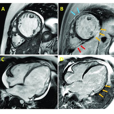 Cardiac Magnetic Resonance Cmr Cine Imaging Of A 24 Years Old Dmd