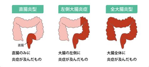 潰瘍性大腸炎 かいようせいだいちょうえん とは 済生会