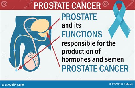 Diagram Of Prostate Cancer Illustration Prostatitis Benign Prostatic