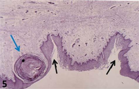 Nasopalatine Duct Cyst Histology